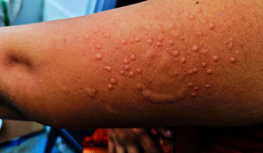 Guideline on mpox