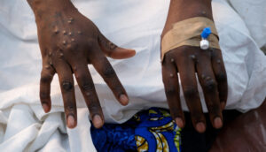 Marburg outbreak in Rwanda
